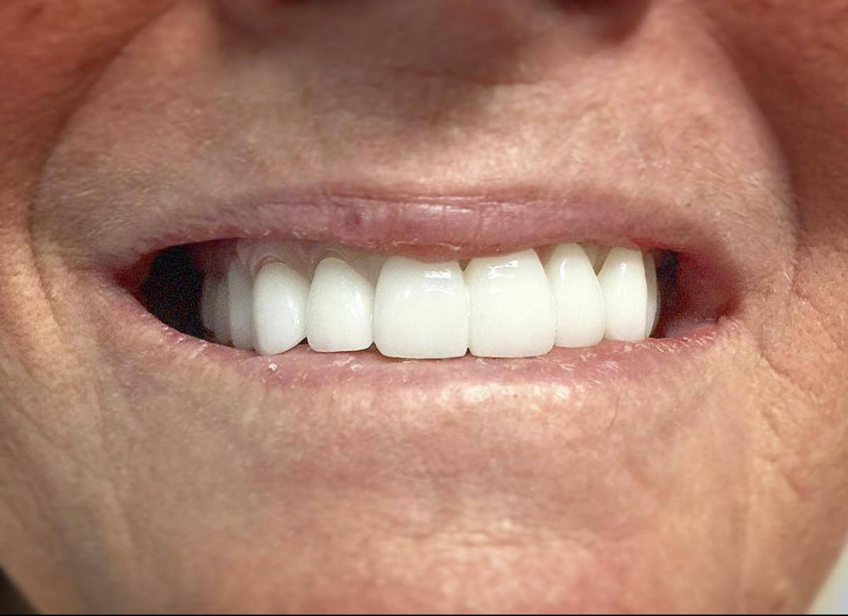 Porcelain veneers — before & after