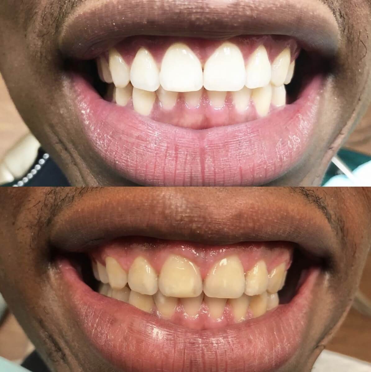Cosmetic dentistry result