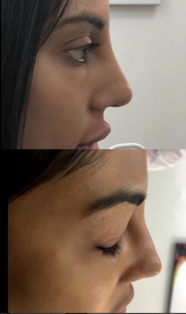 Non-surgical rhinoplasty result