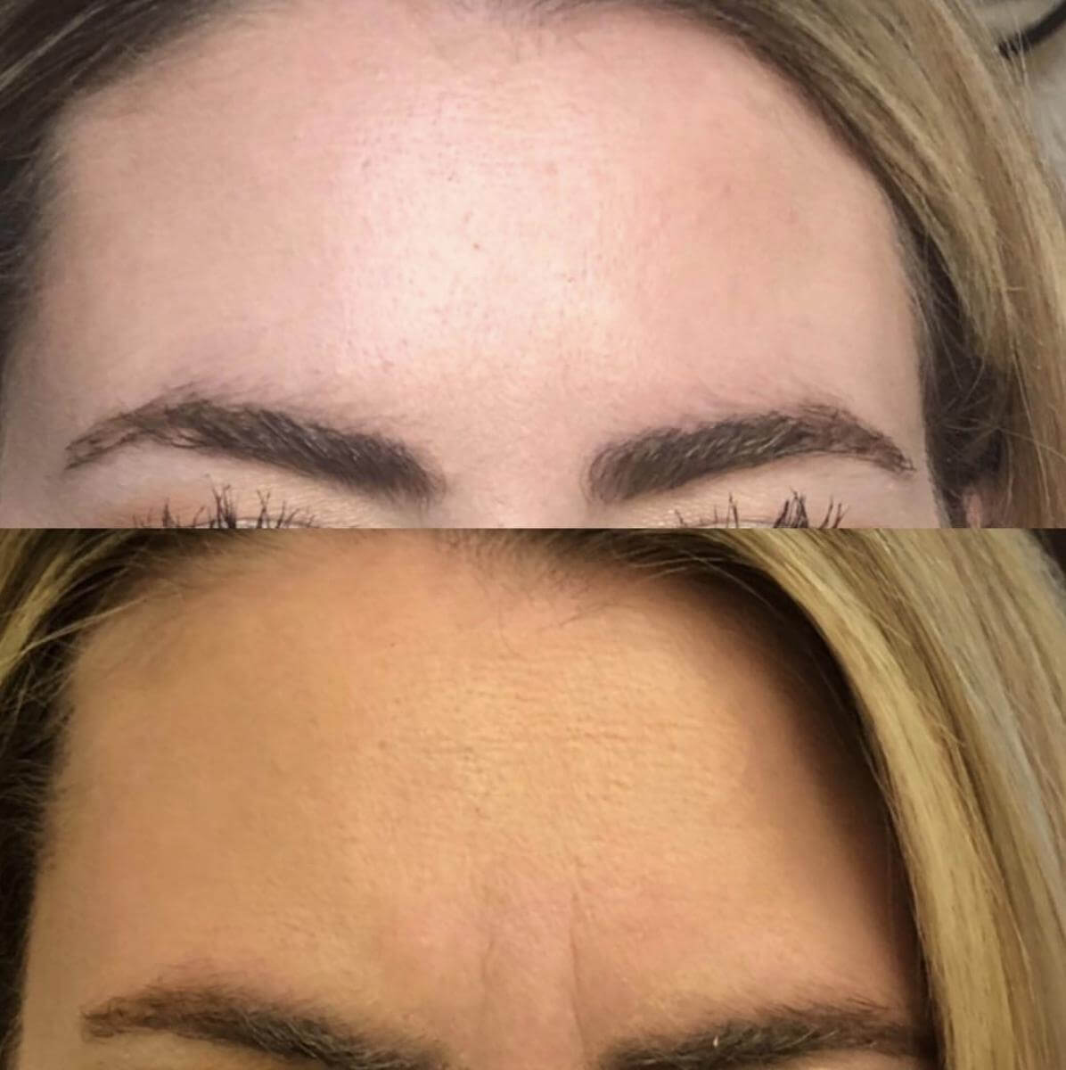Facial rejuvenation result