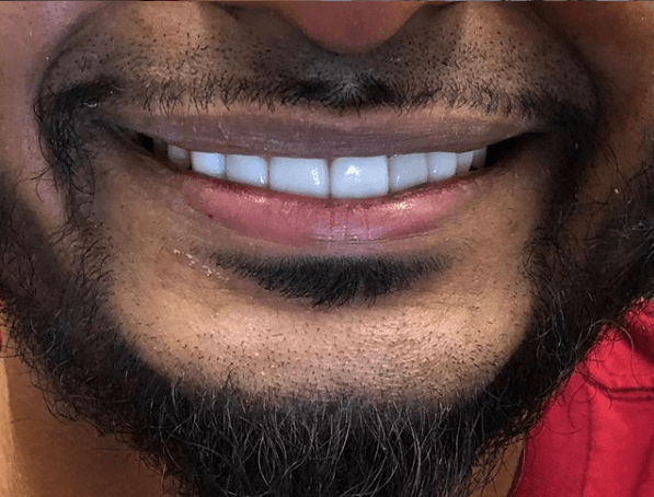 Dental aesthetics result