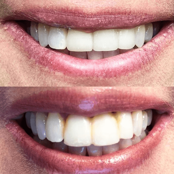 Restorative dentistry result