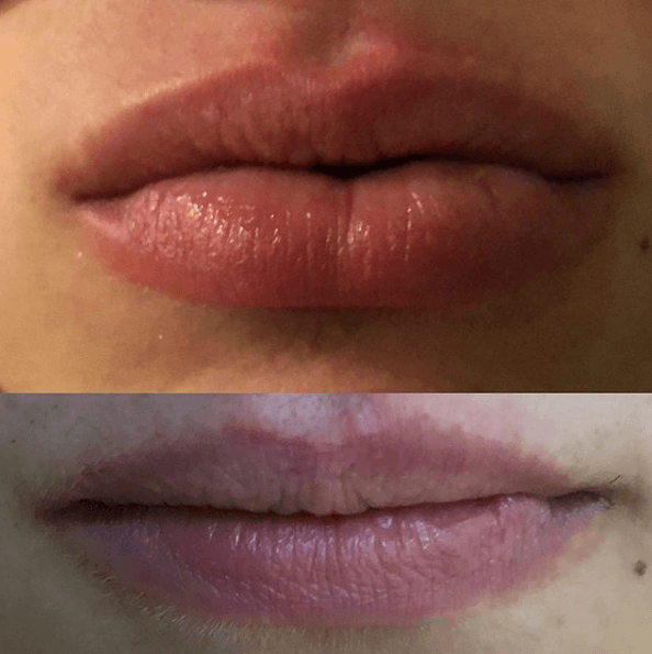 Dental restoration result