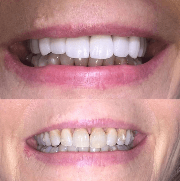 Smile design result